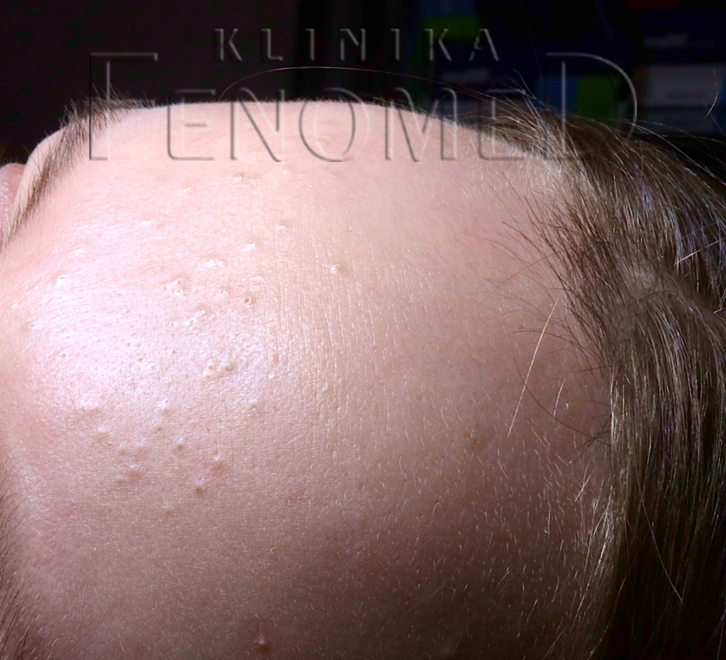 zaskórniki na czole