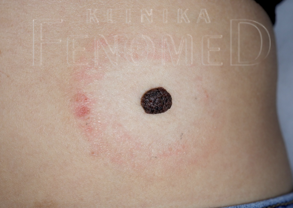 Znamię melanocytarne złożone brodawkujące wrodzone na skórze brzucha