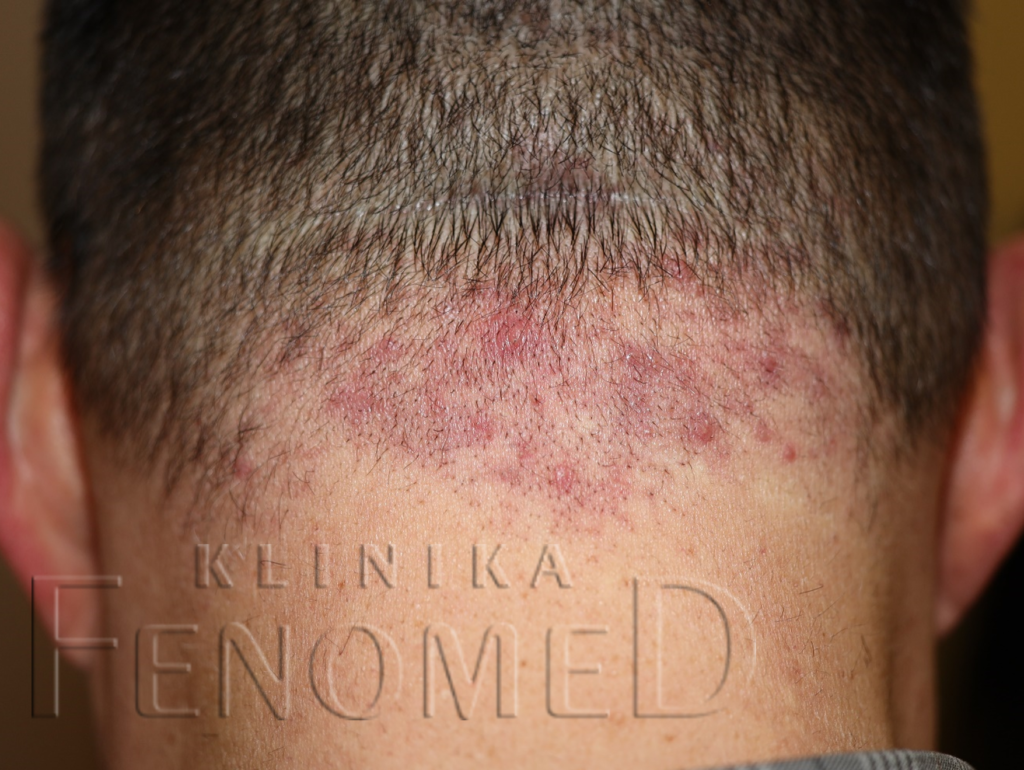 Zapalenie mieszków włosowych