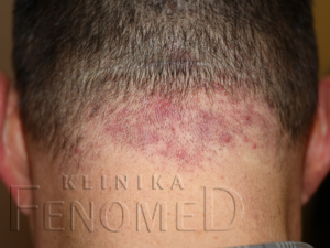 Zapalenie mieszków włosowych