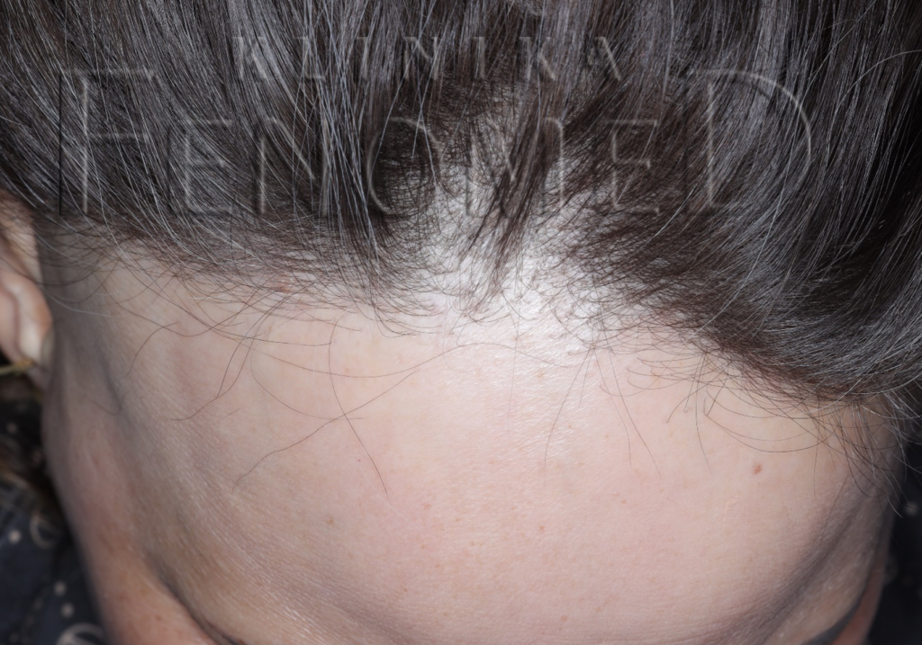 Łysienie czołowe bliznowaciejące