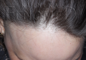 Łysienie czołowe bliznowaciejące