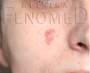 Granuloma faciale