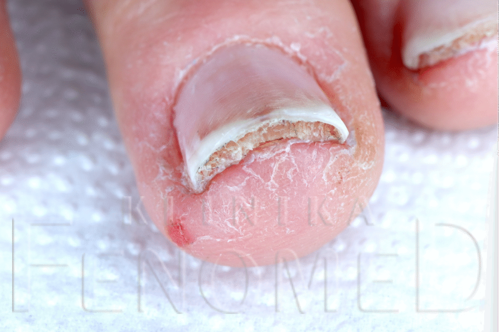 Onycholiza paznokci oraz hiperkeratoza podpaznokciowa spowodowana stosowaniem lakieru hybrydowego.