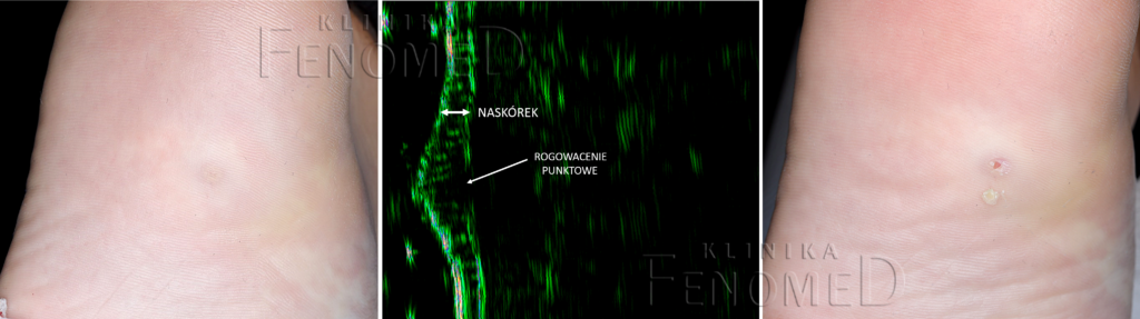 rogowacenie-punktowe