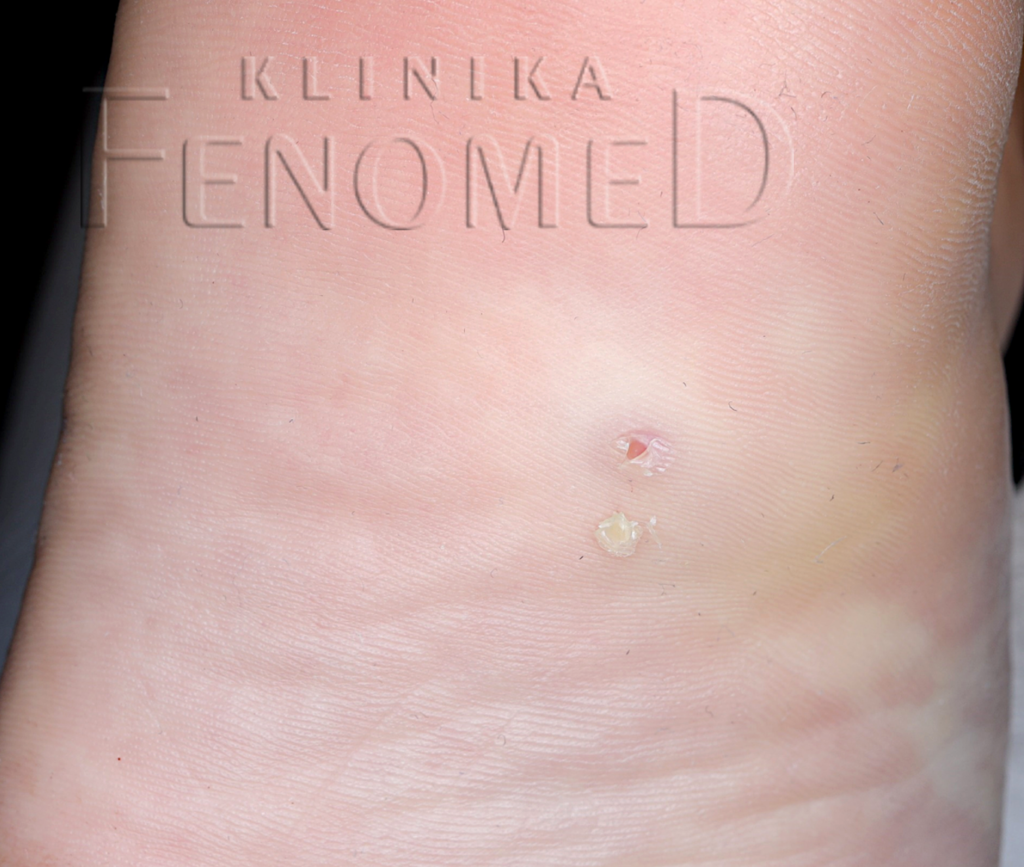 Rogowacenie punktowe