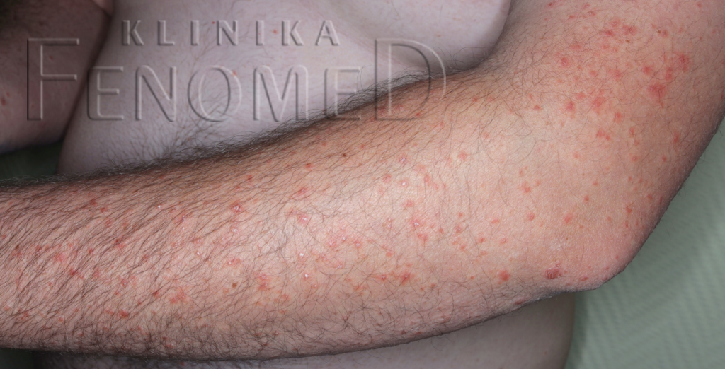 wielopostaciowe osutki swietlne