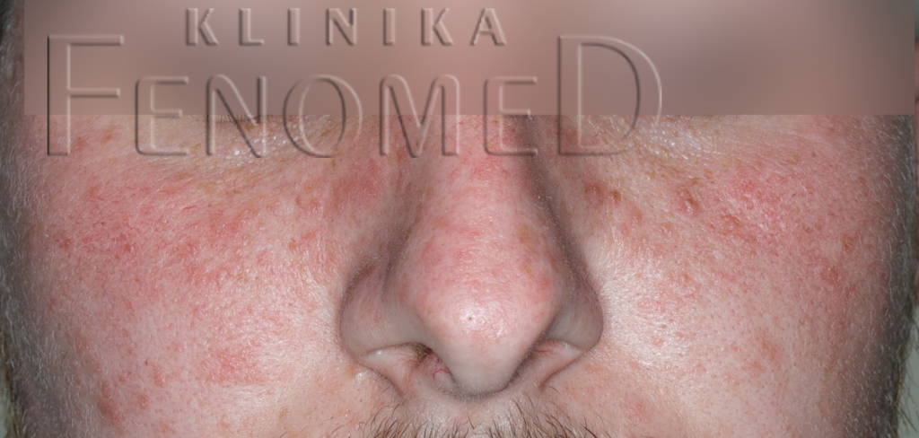 wielopostaciowe osutki swietlne