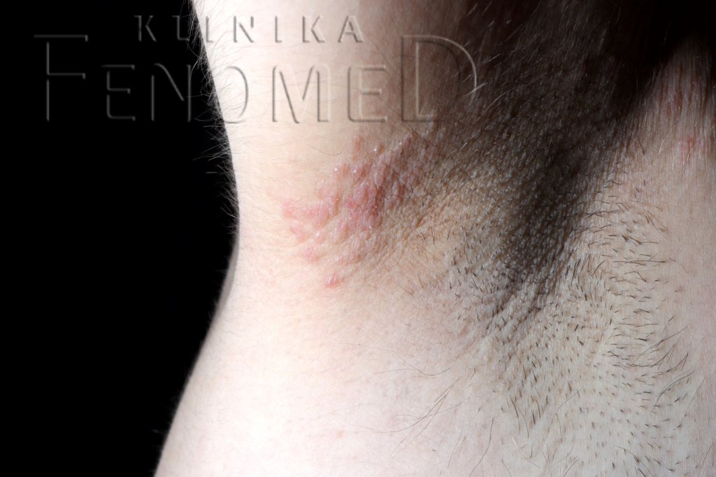 choroba Foxa-Fordyce’a