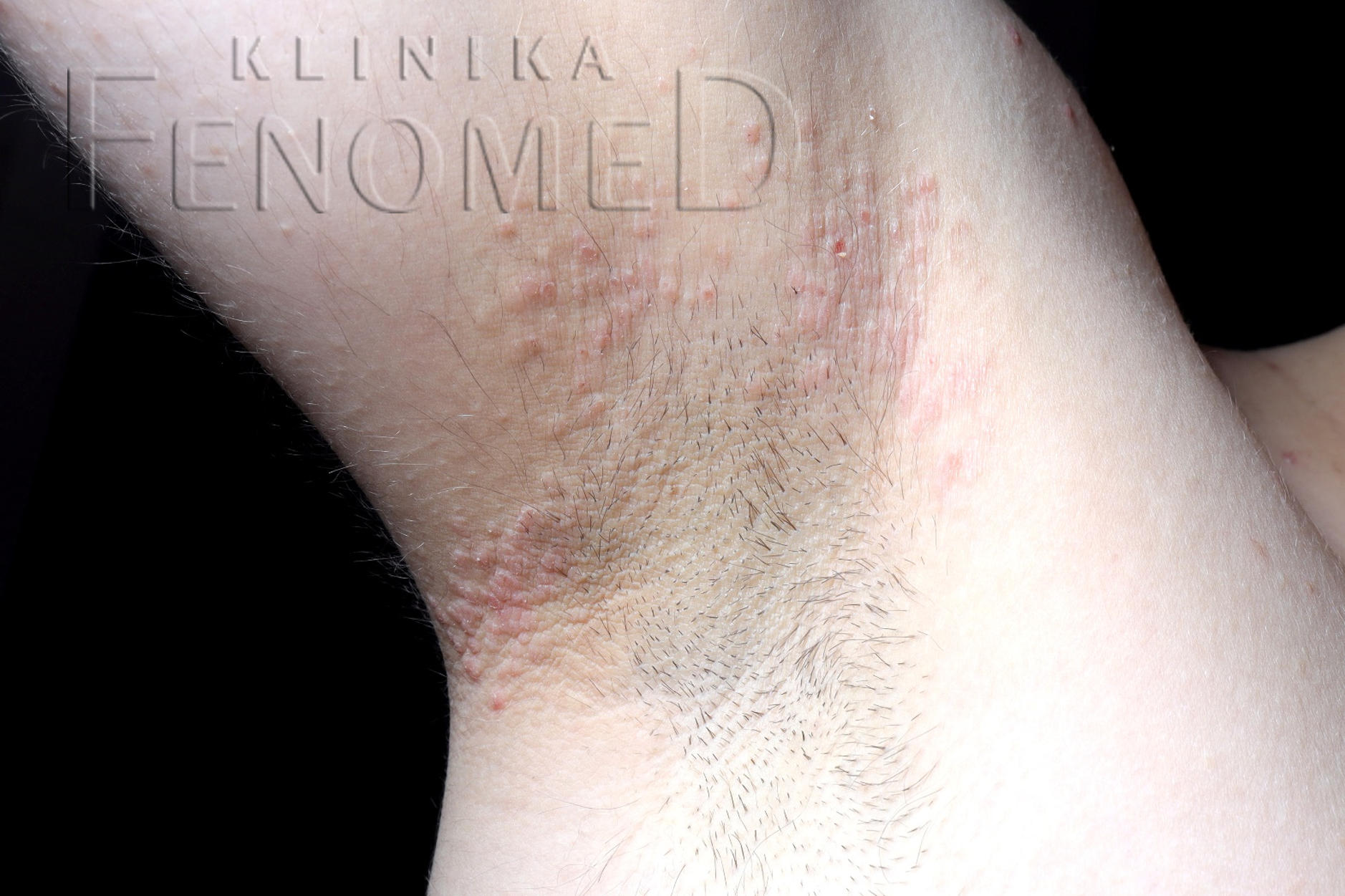 choroba Foxa-Fordyce’a