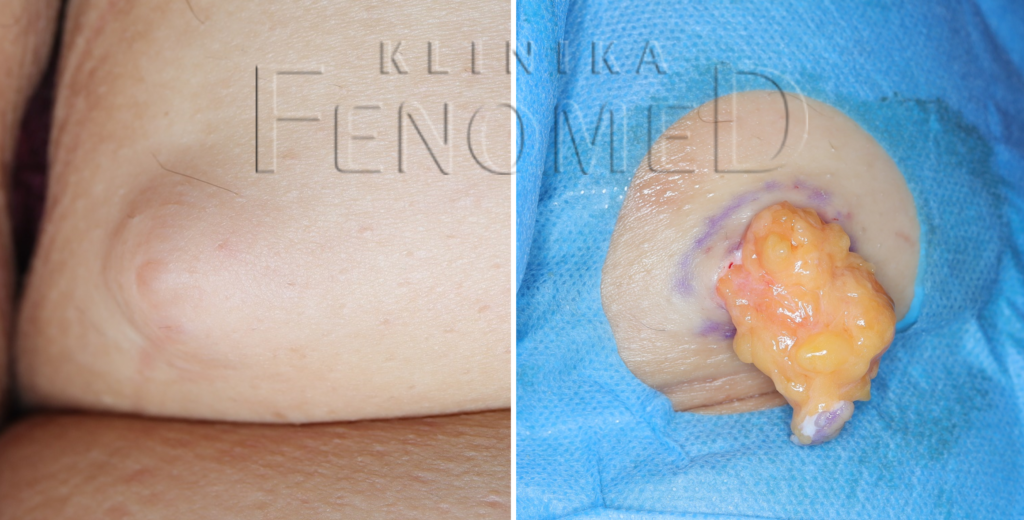 Tłuszczak na skórze pośladka i podczas zabiegu.