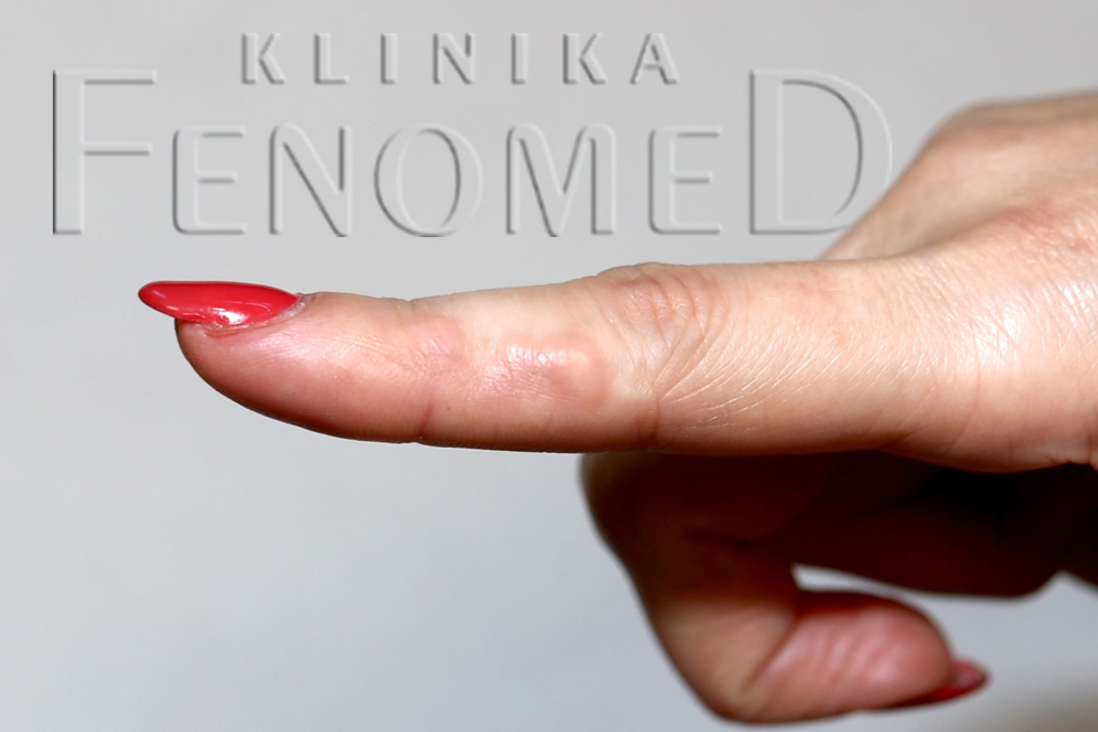 Guzki reumatoidalne (noduli rheumatologici)