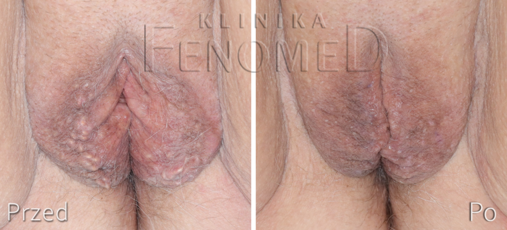 guzki-na-wargach-sromowych