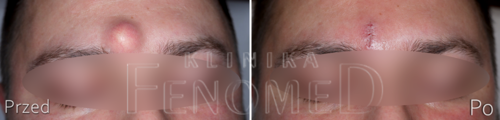 Kaszak na skórze czoła. Efekt przed i 7 dni po zabiegu.