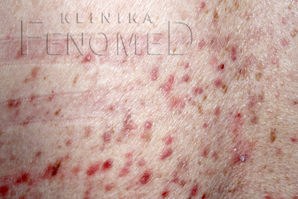 Pokrzywka barwnikowa