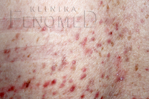 Pokrzywka barwnikowa