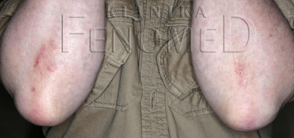 czerwone-na-lokciach