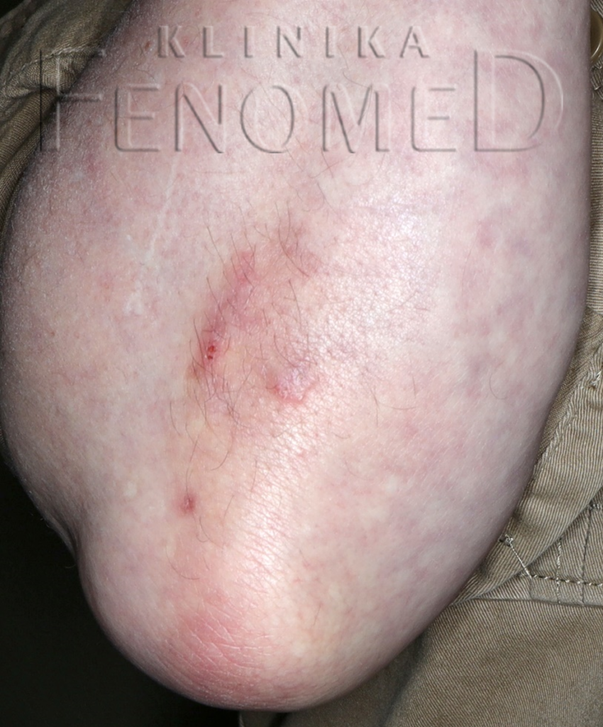 Zgrubienie naskórka