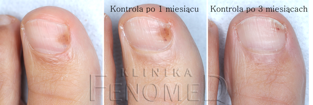 czerwona-plama-pod-paznokciem