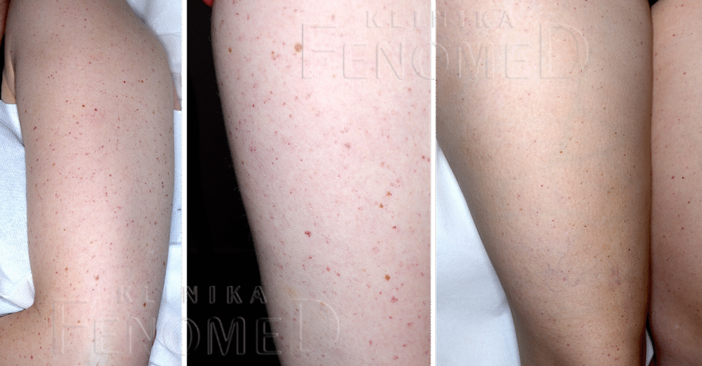 Choroba Rendu-Oslera-Webera