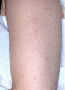 Choroba Rendu-Oslera-Webera