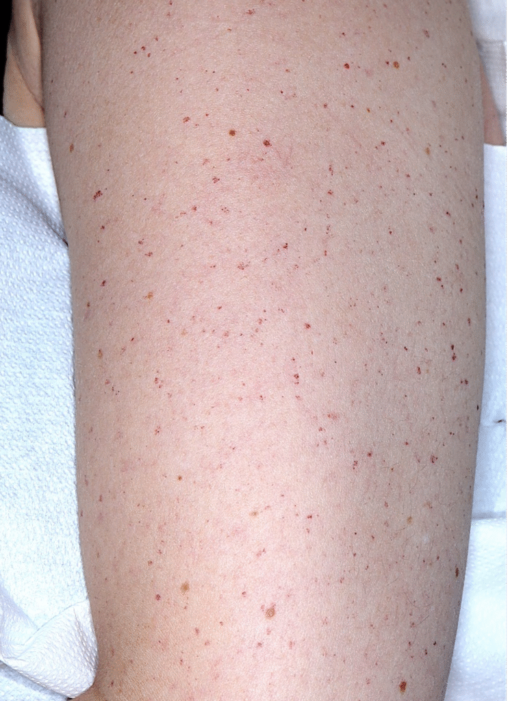 Choroba Rendu-Oslera-Webera