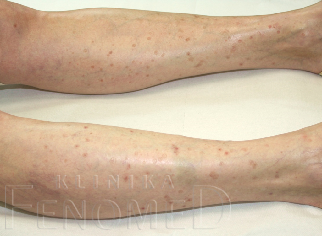 Superficial Actinic Porokeratosis