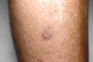 Actinic porokeratosis
