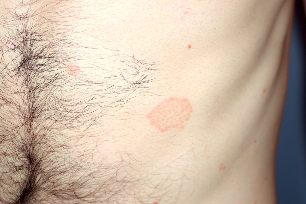 Łupież różowy Gilberta