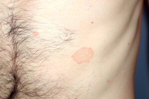 Łupież różowy Gilberta