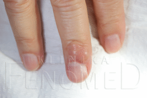 Kłębczak (glomus tumor)