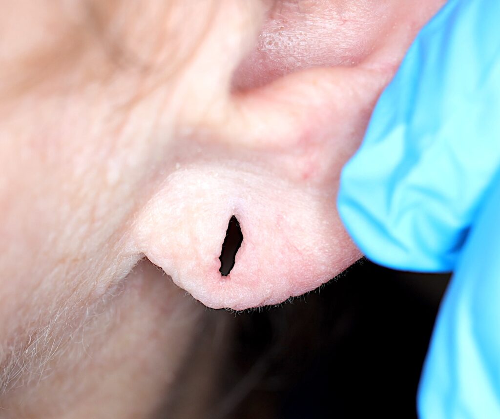 Rozerwany płatek małżowiny usznej