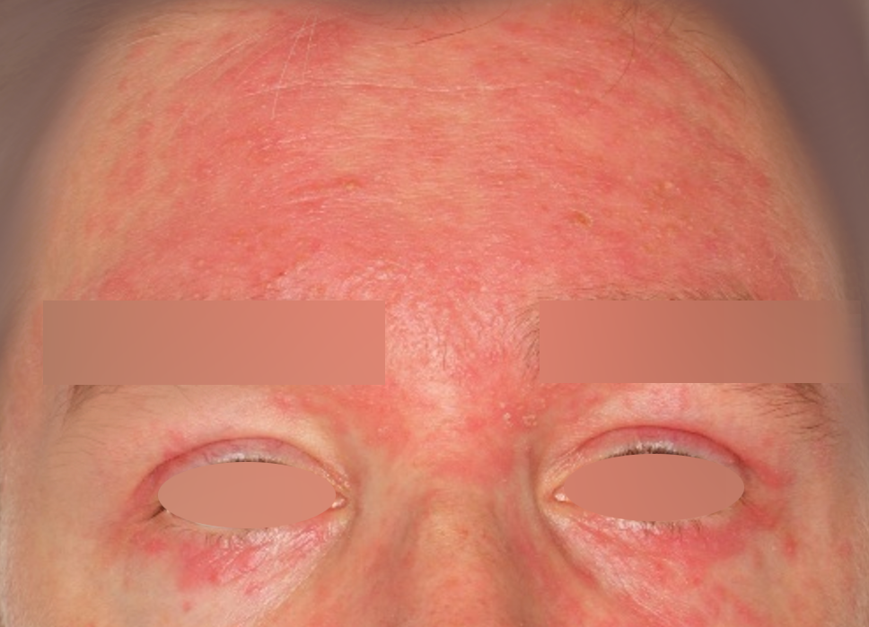 Trądzik posterydowy