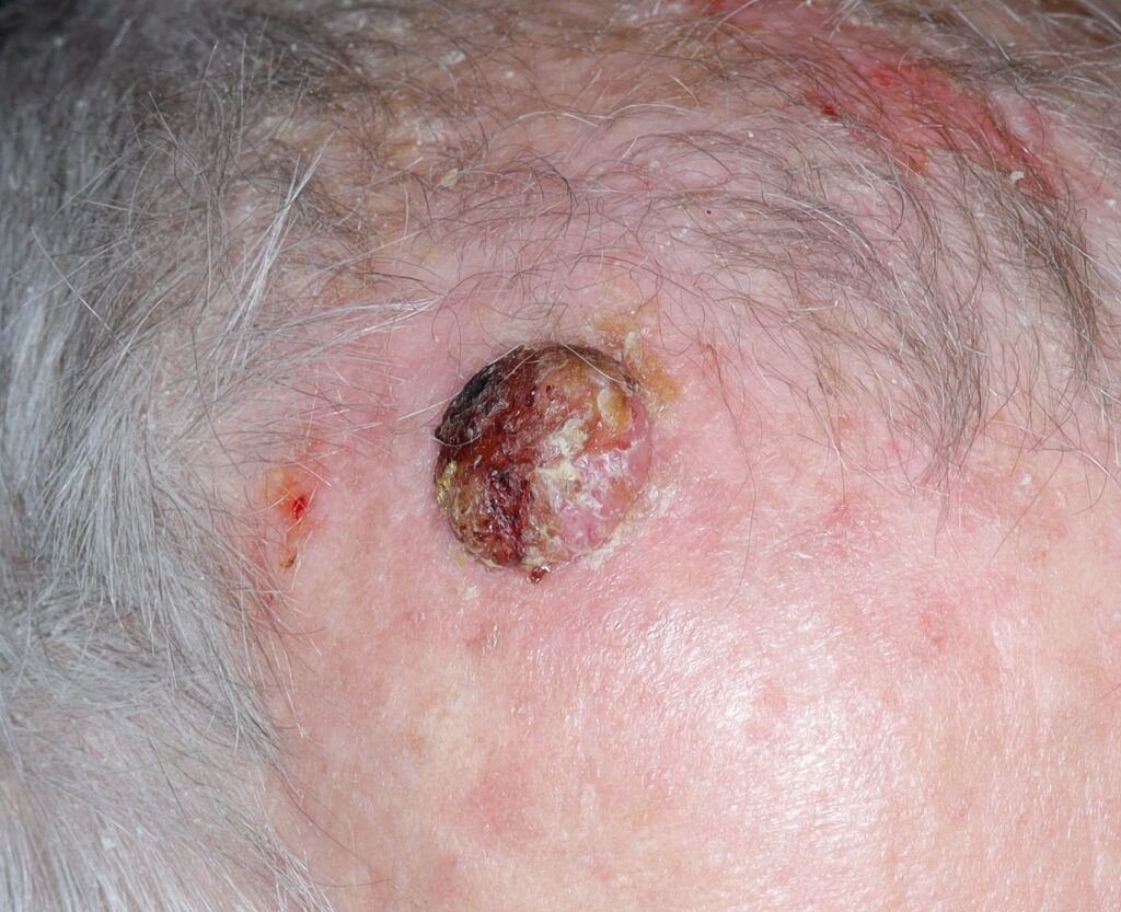 Rak płaskonabłonkowy skóry