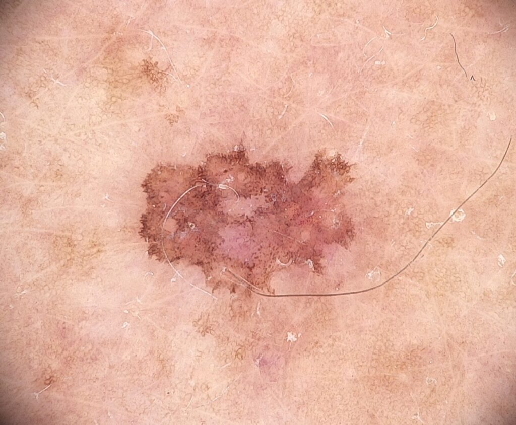 Znamię dysplastyczne